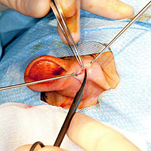 Endoscopic ear surgery and advanced ear care